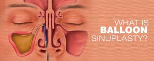 What Is Balloon Sinuplasty?